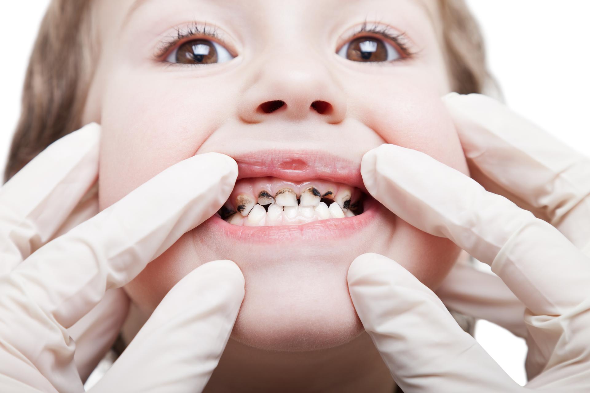 This is the image for the news article titled Causes and Remedies for Teeth Discoloration in Children