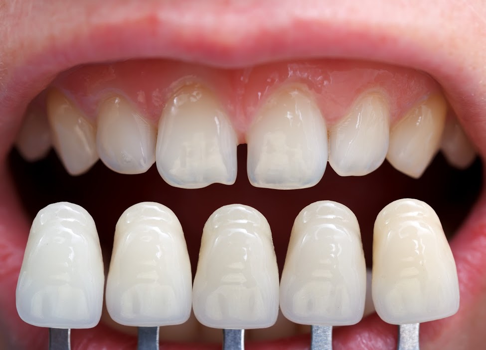This is the image for the news article titled 3 Dental Problems That Porcelain Veneers Can Fix